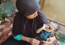 Ariansyah Penderita Tumor Mata Butuh Uluran Tangan
